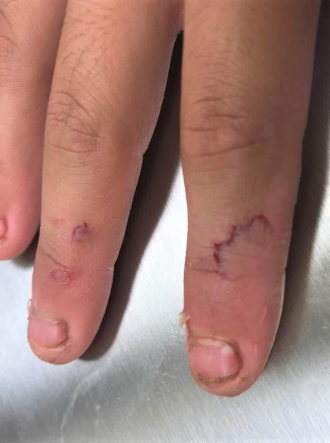 kids cut fingers